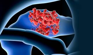 Vaccine Combination Improves Survival in Metastatic Pancreatic Cancer Vaccine Combination Improves Survival in Metastatic Pancreatic Cancer